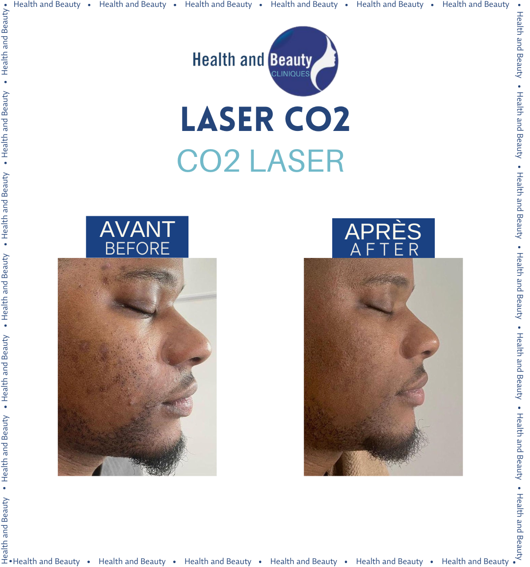 resultat laser CO2 cicatrice acne